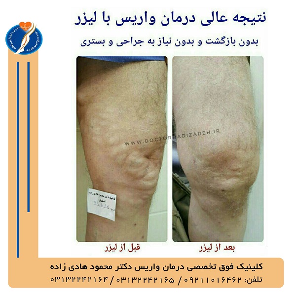 هزینه درمان واریس در اصفهان